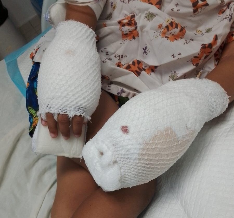 Niño que madre le habría quemado las manos se encuentra estable post thumbnail image